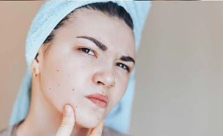 Shop Affordable Acne Skin Care: Buy Treatments That Work
